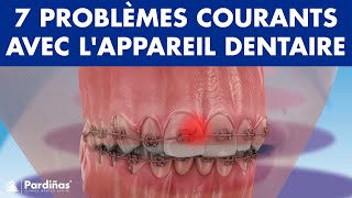 Urgence orthodontique  7 PROBLÈMES courants avec lAPPAREIL dentaire © [upl. by Loutitia]