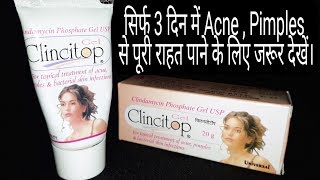 Clincitop Gel For Acne Pimples Remover Full Review By Anmol Hindi [upl. by Klein385]