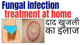 Fungal infection treatment at home  Khujli ki medicine  Daad ki best medicine [upl. by Yeniffit]