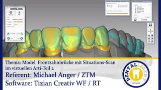 Dentaltechnik CADCAM  Teaser  Model einer FrontzahnBR mit SituationsScan im virt Arti Teil 2 [upl. by Bautista170]