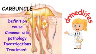 Carbuncle definition causes common site pathology investigations treatment [upl. by Aciemaj748]