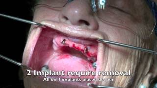 How to remove a dental implant  Explicit 3 cases [upl. by Lipson]