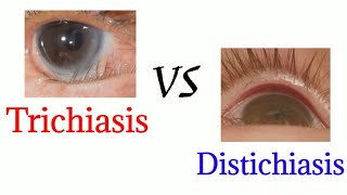 Difference between trichiasis and distichiasis  optometry club [upl. by Rickert414]