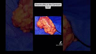 Diverticulitis and Diverticulosis on the Carnivore Diet [upl. by Asseral]