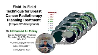 Field in Field Technique for Breast Cancer Radiotherapy Planning Treatment [upl. by Arleta]