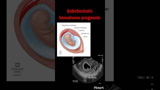 Subchorionic hematoma prognosis  Miscarriage rate following vaginal bleeding in pregnancy [upl. by Clary812]