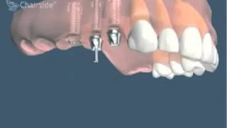 Implants dentaires et bridge sur implants pour remplacer plusieurs dents [upl. by Timi]