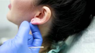 Earlobe Repair  Clinique Dallas Plastic Surgery [upl. by Myrah]