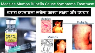 MMR  Measles Mumps Rubella Cause Symptoms Diagnosis Treatment in Hindi  Measles Mumps Rubella [upl. by Adianes]