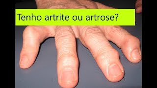 Como diferenciar artrose de artrite nas mãos guia simples e completo [upl. by Akimahs]