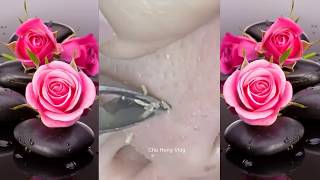 How to Remove whiteheads and acne on the nose2 [upl. by Hermia586]