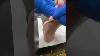 Discover easy bunionette callus removal by an Australian podiatrist FootCare PodiatryDownUnder [upl. by Arrahs]