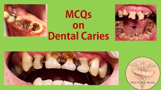 Oral Pathology MCQs  Dental caries for NBDE NDEB AIPGEE AIIMS ADA ADC etc [upl. by Ahseenak380]