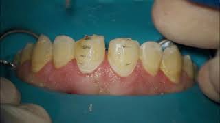 diastema closure with ceramic veneer [upl. by Dunn]