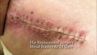 A More Patient Centric Solution To Metal Skin Staples in Surgery Absorbable Skin Staples [upl. by Fahy]