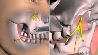 мандибулярная анестезия по вазирани акинозиmandibular anesthesia for Vazirani akinozi [upl. by Schuh]