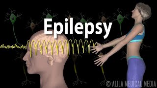 Epilepsy Types of seizures Symptoms Pathophysiology Causes and Treatments Animation [upl. by Niwde738]