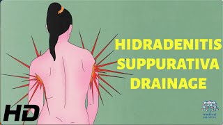 Hidradenitis Suppurativa Drainage How to Minimize Pain and Discomfort [upl. by Danell]