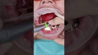 Dental implant’s All on 4 in Prague shorts dentist dental implant veneers short [upl. by Orsini279]