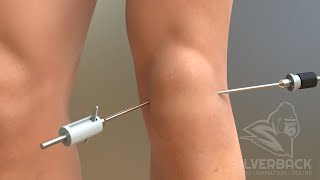 Knee Arthroscopy Animated Video [upl. by Parsaye]