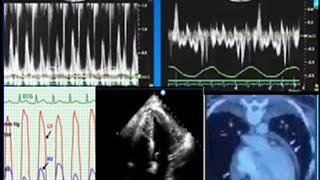 Constrictive pericarditis diagnosis echocardiography and treatment [upl. by Onra86]