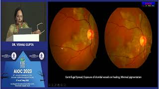 AIOC2023 GP97 topic Dr Vishali Gupta Patient with choroiditis [upl. by Hyams]