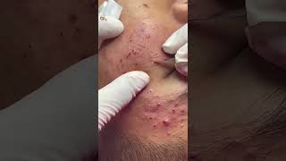 Best Pimple Popping 04 beautiful blackheads sacdepspa [upl. by Amethyst]