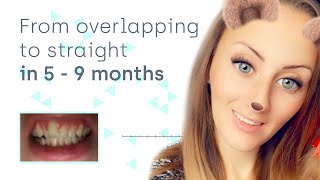 Easily straighten overlapping teeth at home with invisible aligners [upl. by Anavahs]