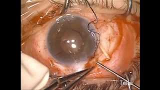 Sulcus Baerveldt Glaucoma Implant Celso Tello MD [upl. by Eitsirhc105]