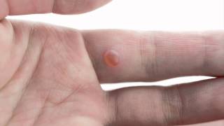 Should you cut off your warts Dr Sarah Noory of DMC SinaiGrace Hospital answers this question [upl. by Ivor286]