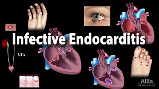 Infective Endocarditis Animation [upl. by Cleon]