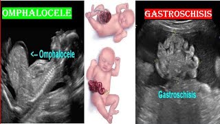 Omphalocele VS Gastroschisis on Ultrasound [upl. by Eniawed]