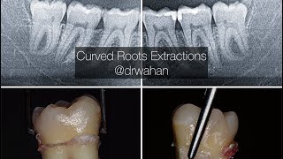 Erupted Wisdom Teeth with Curved Roots Extraction Video [upl. by Gunilla]