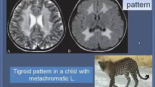 White Matter disease Part 2 [upl. by Eleira]