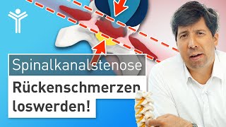 Rückenschmerzen durch Spinalkanalstenose richtig behandeln  Wann operieren [upl. by Yesrej835]