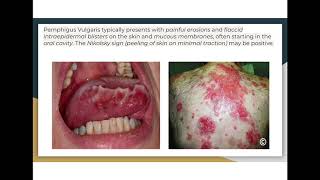 Autoimmune diseases pemphigus vulgaris vs bullous pemphigoid [upl. by Anele]