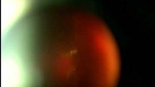 An Amazing Laser Eye Floater case by Scott Geller MD Florida USA tel 2392758222 [upl. by Neilla]