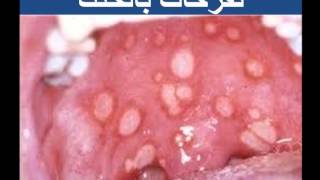 متلازمة بهجت للدكتور فهيد السبيعي BEHCETS DISEASE DRFOHEID ALSOBEI [upl. by Rillis]