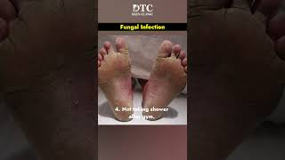 What is Fungal Infection amp Its Treatment  DTC Skin Clinic [upl. by Macnamara102]