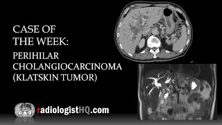 Case of the Week Perihilar CholangiocarcinomaKlatskin Tumor CT amp MRI [upl. by Mooney]