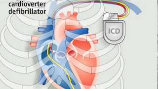 How pacemakers work [upl. by Ambrogino]