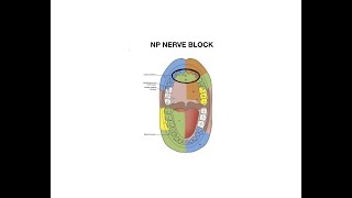 Nasopalatine Nerve Block Injection [upl. by Amar]