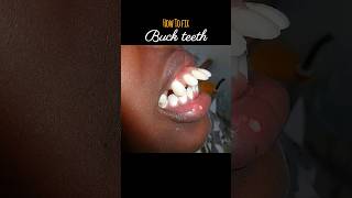 Braces for buck teeth braces orthodontist dentist dental [upl. by Collimore47]