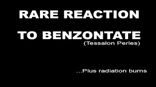 Unable to speak  Benzonatate Reaction [upl. by Trella486]