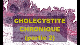 CHOLECYSTITE CHRONIQUE partie 2  PATHOLOGIE [upl. by Harald497]