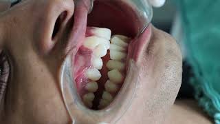 Backward Path of Closure  Occlusion in Orthodontics [upl. by Leandre]