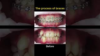 The process of braces 26 months [upl. by Otanutrof]