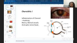 Homoeopathy for Choroiditis [upl. by Nairbal845]