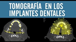 La importancia de la tomografía en los implantes dentales  Juan Fernando Salgado [upl. by Milda]