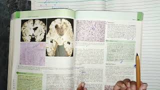 CNS tumors part 3 oligodendrocytoma ependymoma cnspathology robbins pathology [upl. by Balthazar]